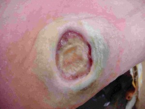 %d7%a4%d7%a6%d7%a2-%d7%9c%d7%97%d7%a5